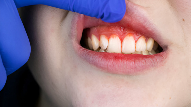 7 Penyakit Gigi yang Bisa Berakibat Fatal Jika Dibiarkan, Jangan Disepelekan!