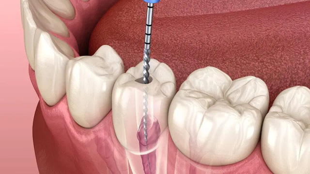 Penjelasan Tentang Root Canal, Kondisi Infeksi di Dalam Saluran Akar Gigi