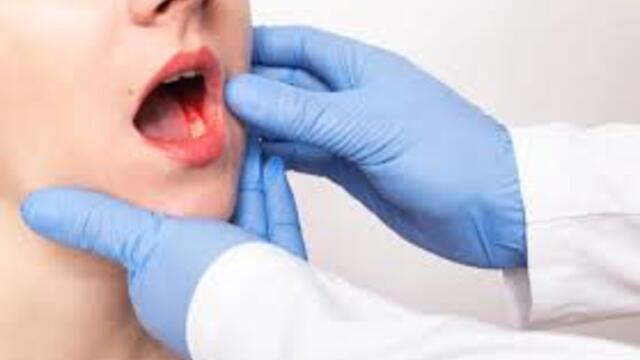 Cara Mengatasi Gusi Berdarah